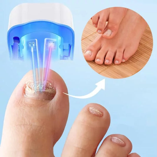 Dispositivo Láser para Limpiar Hongos en Uñas